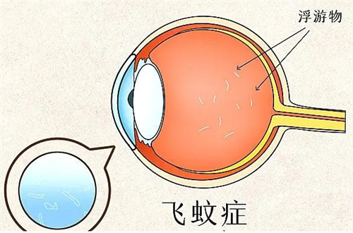 眼睛看东西有黑影飘动是飞蚊症吗，一般多久会消失治疗贵不贵？