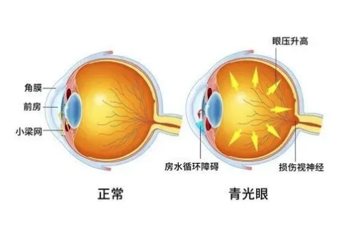 青光眼的症状和表现是什么?文内介绍下症状、类型、治疗方式!