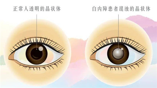 面对白内障引发的视力模糊,手术治疗是否是较佳选择?