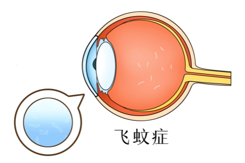 眼科新知：飞蚊症是白内障的前期吗？飞蚊症与早期白内障有关系吗？一文讲清两者区别