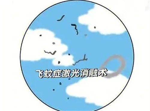 飞蚊激光消融术6个月回访资料公开：病因/改善建议/消融术后感受分享 