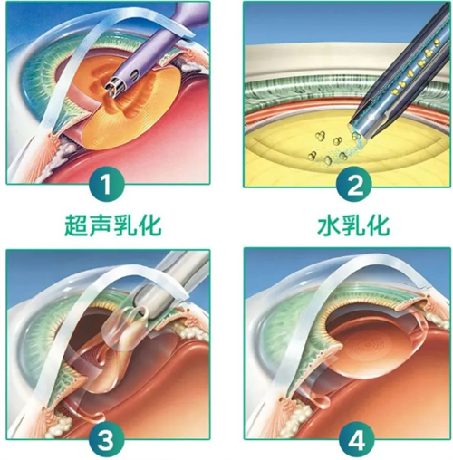 超声乳化白内障吸除术怎么做?分享手术原理和收费标准!