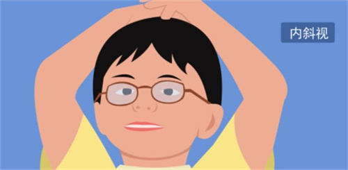 小孩眼睛外斜视的常见误区:手术真的必要吗?