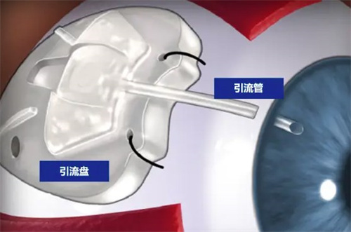 青光眼手术大概需要多少钱,分享不同手术方式特点和收费标准!