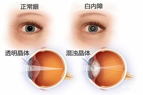 哈尔滨白内障手术价格一览：传统白内障6000+超声乳化白内障8000+飞秒激光15000+