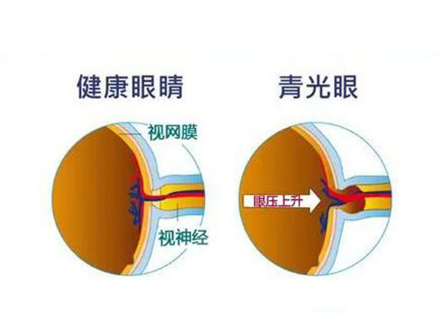 青光眼和健康眼睛对比