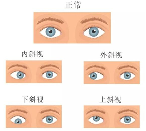 斜视眼外肌手术风险大吗？本文为大家深入探讨一下！