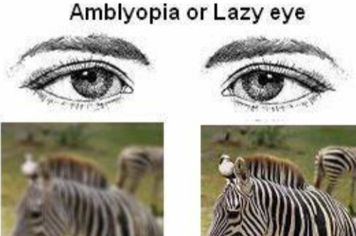 弱视视物对比图