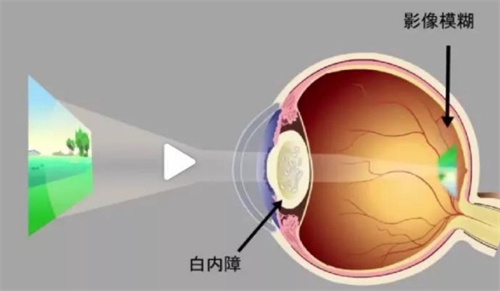 做白内障换晶体哪种比较好？不同晶体特点不同别选错！