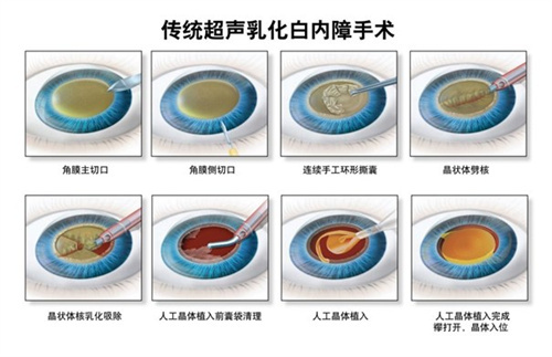 白内障的症状和表现特点介绍，有这些情况一定要注意！