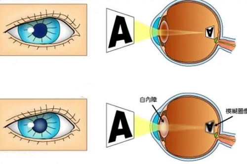 【速看】临沂白内障手术免费政策新规定，怎么申请白内障免费手术？申请攻略一文读懂！